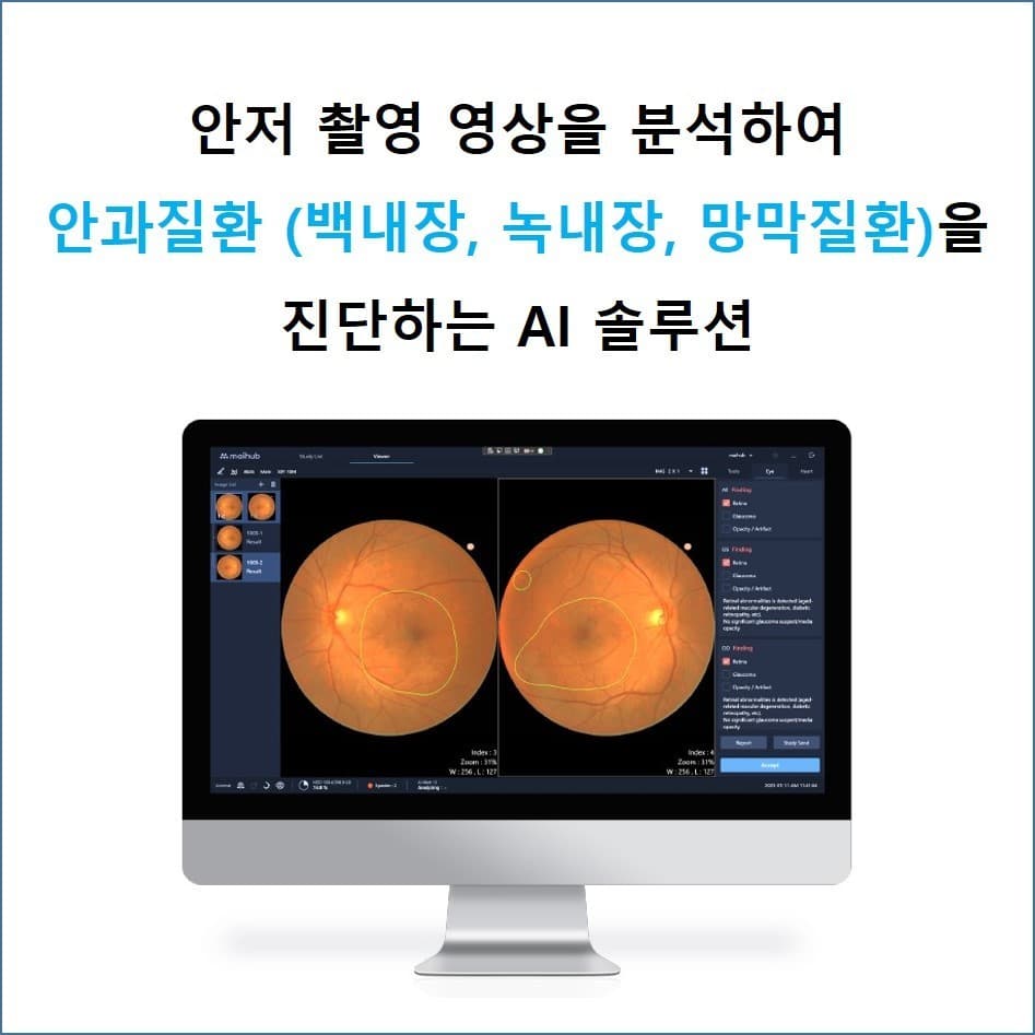 안과질환 진단 및 심혈관질환 발생 위험도 예측 AI 솔루션